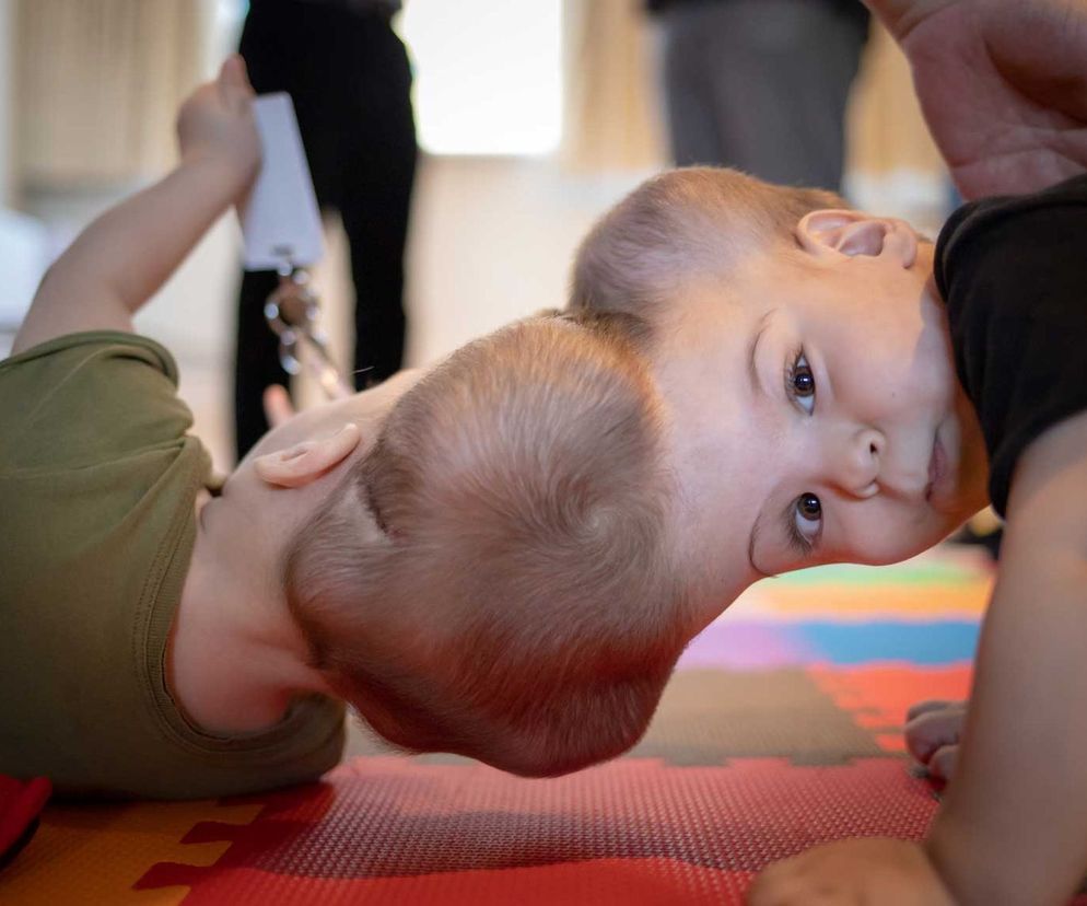 Rozdzielono bliźnięta syjamskie złączone mózgami. Pomogły techniki wirtualnej rzeczywistości