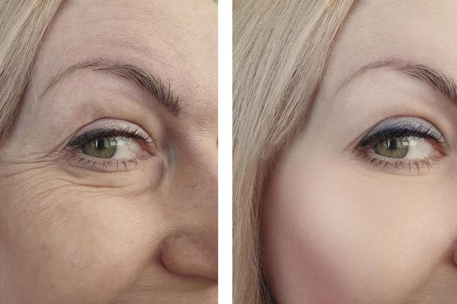 Maść z PRL-u na zmarczki i kurze łapki. Działa jak botox, a kosztuje tylko 5 złotych