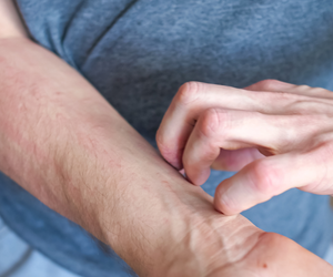 Zmiany skórne wędrowały po jego ciele. Okazało się, że pod skórą pełzały robaki