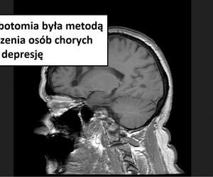 W tych przypadkach stosowano lobotomię