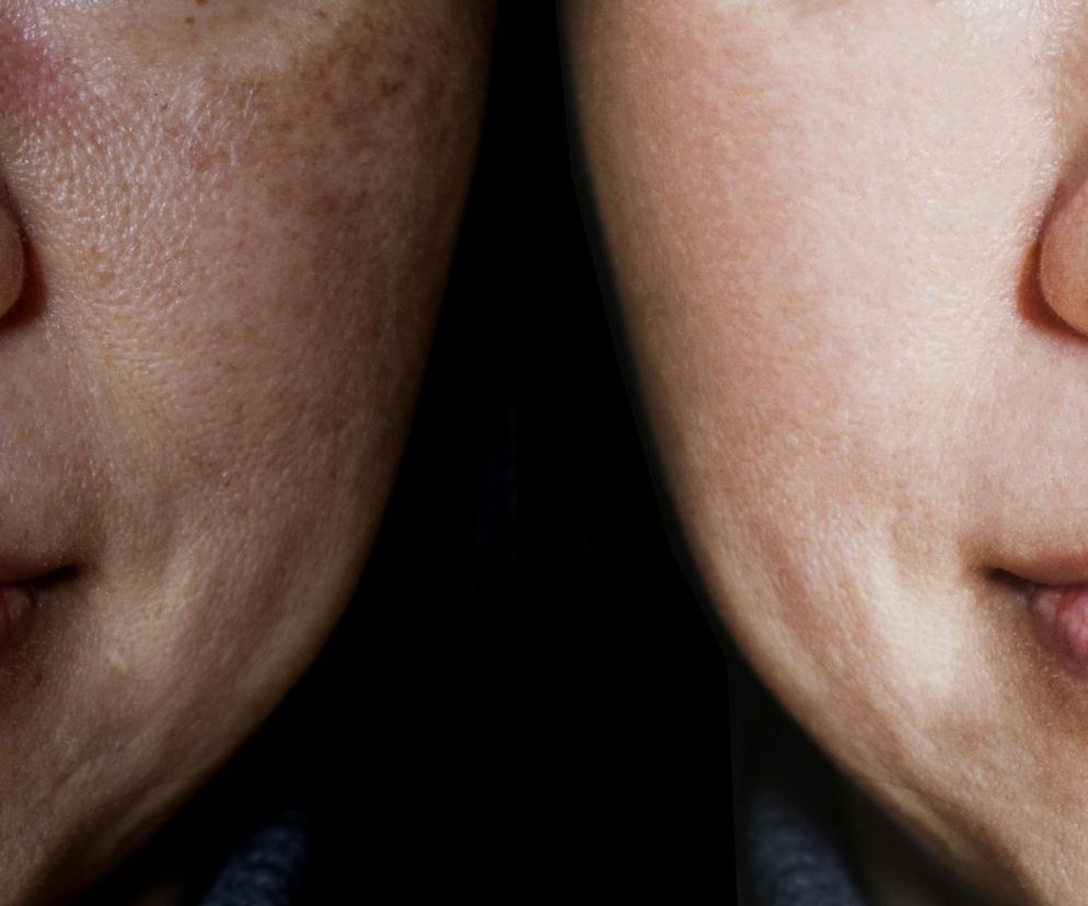  Domowa maseczka na przebarwienia, zmarszczki, naczynka. Wszystkie składniki znajdziesz w kuchni