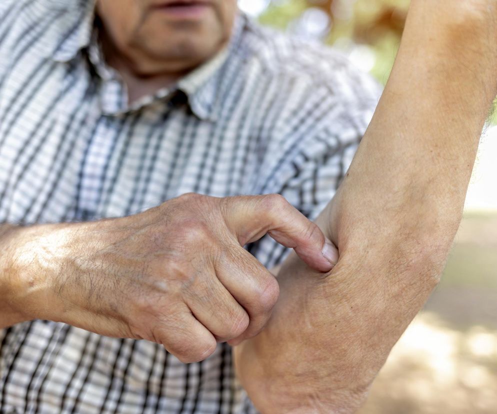 Wysypka po zjedzeniu hamburgera? To może być zespół alfa-gal