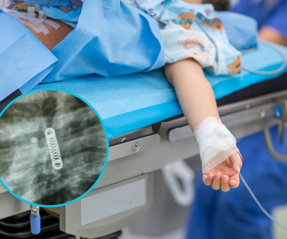 Jedynym objawem był kaszel. Lekarze znaleźli to w jego płucach