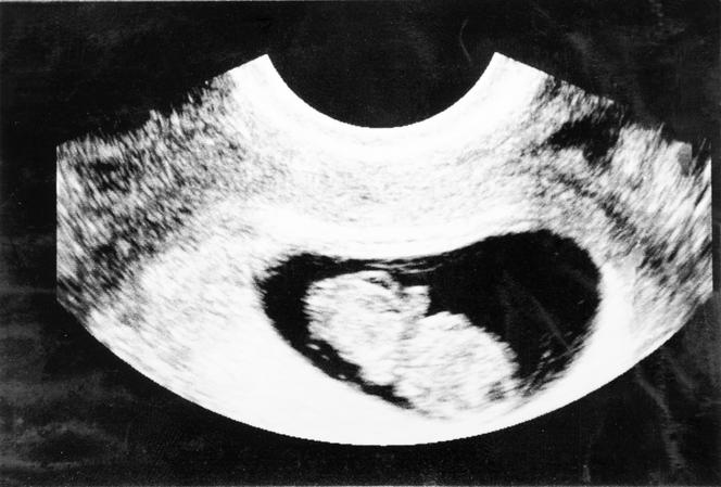 9 tydzień ciąży - USG