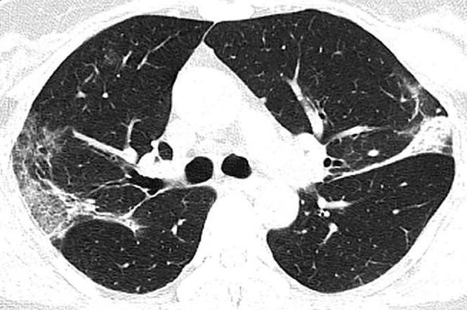 Tak wyglądają płuca 44-letniej ofiary koronawirusa