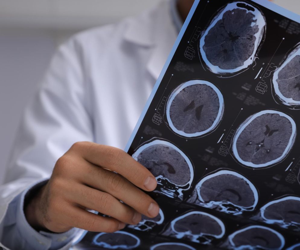 Mózg kobiet po udarze regeneruje się słabiej niż mężczyzn. Jeden kluczowy czynnik utrudnia proces