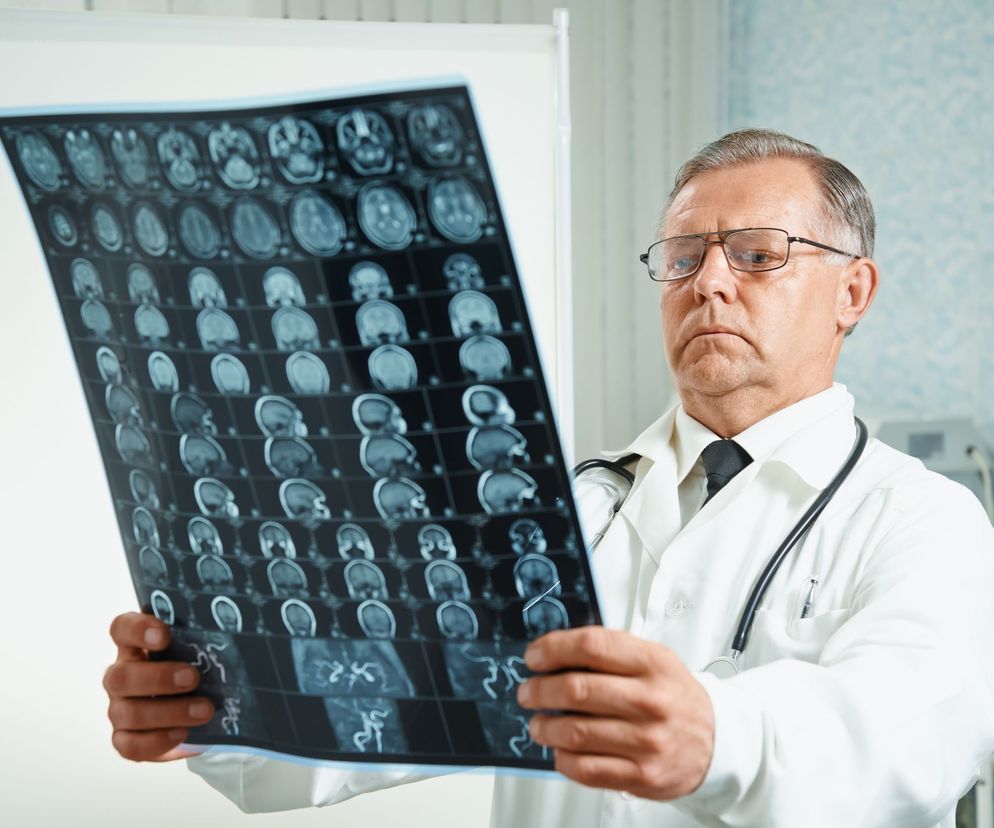 Gwiaździak (astrocytoma) jest jednym z najczęściej występujących guzów układu nerwowego, należącym do glejaków.