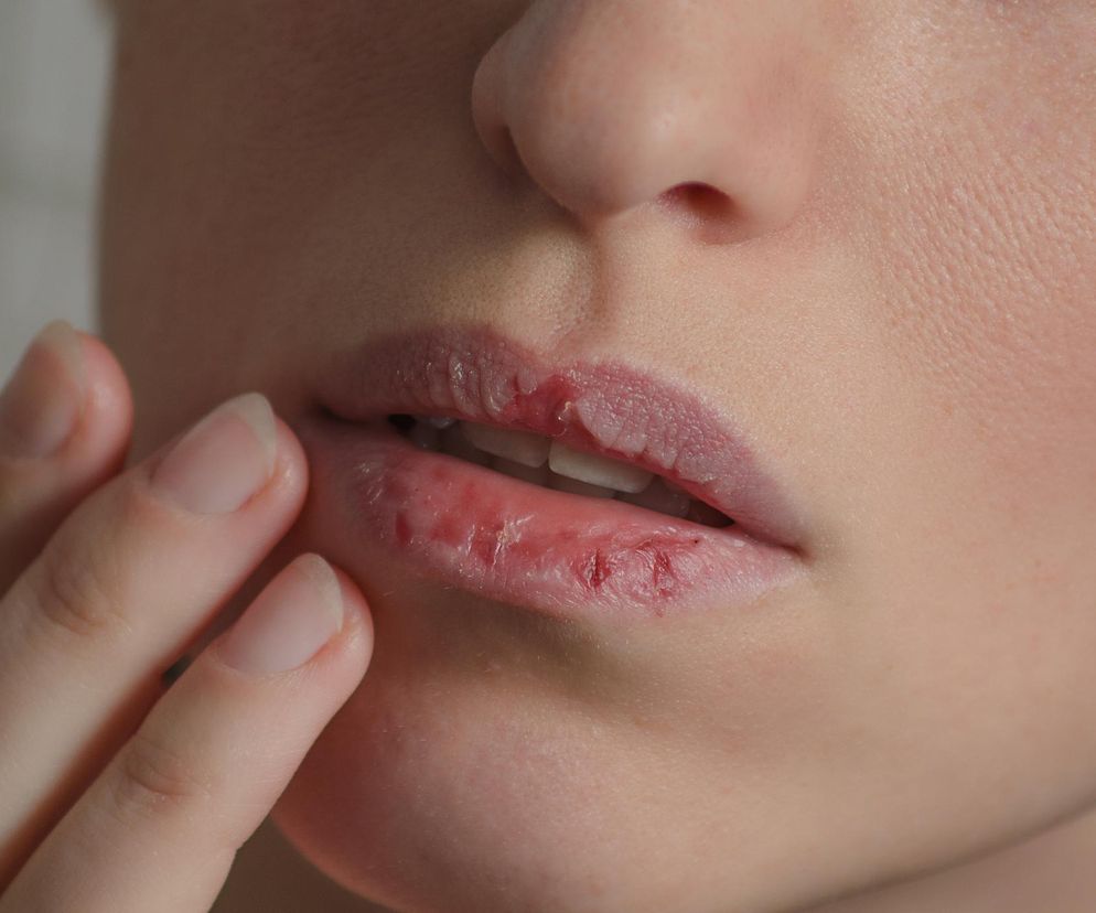 Pozbądź się zimowej frustracji. Wypróbuj te sposoby na popękane usta