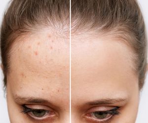 Najlepszy sposób na pryszcze. Kosztuje 5 zł, a działa jak profesjonalny zabieg w salonie