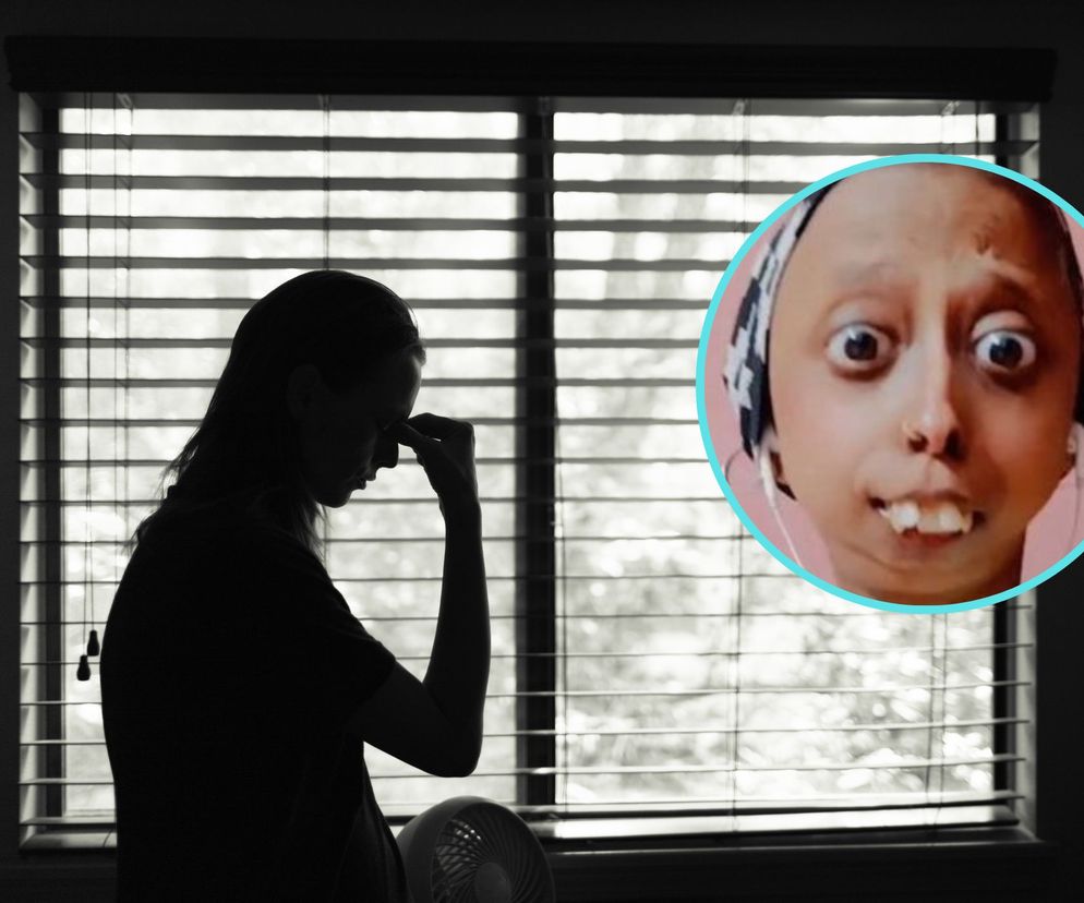 Ma 20 lat, waży 25 kg i nie ma podbródka. Jest odludkiem, bo ludzie nie akceptują jej wyglądu