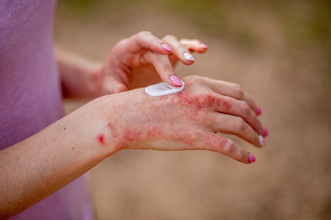 Rozdzierające, pękające pęcherze”. Przez egzemę chciała odrąbać sobie rękę