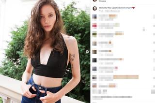 Koszmarny wypadek pięknej modelki. Jej twarz i ręce niemal spłonęły. Wieniawa apeluje o pomoc