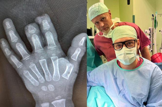  Szybka akcja lekarzy uratowała dłoń 2-latka. Koledzy obdzwaniali całą Polskę