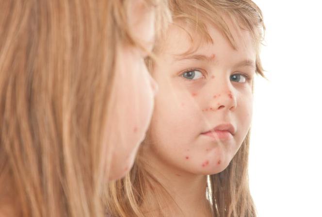 Mięczak zakaźny u dzieci: wirusowa choroba skóry