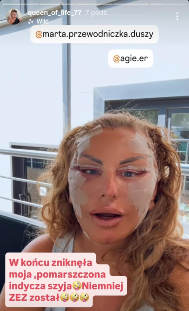 Dagmara Kaźmierska po operacji twarzy