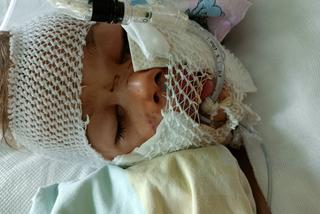 Amstaff rozszarpał buzię 4-letniej Nadii