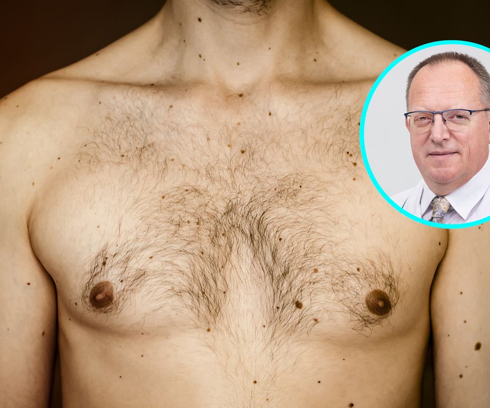 Rak piersi u mężczyzn