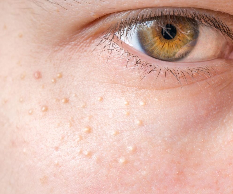 To nie trądzik, ale lepiej ich nie wyciskaj. Dermatolog radzi, jak bezpiecznie pozbyć się prosaków