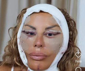 Dagmara Kaźmierska miała operację plastyczną