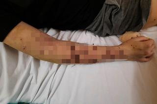 Sfora psów pogryzła 18-latkę pod Łaskiem. Ich właściciel nie przyznaje się do winy [ZDJĘCIA]. 