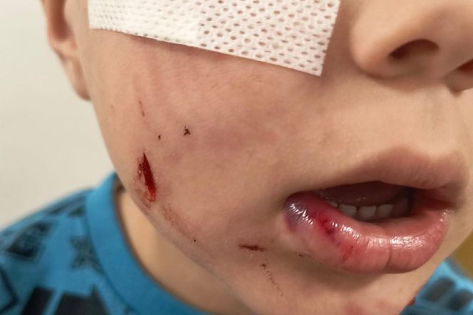 Pogryziony Franek potrzebuje pomocy. Policja szuka właściciela psa. Do szpitala dotarła anonimowa wiadomość