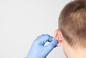Korekcja uszu, czyli plastyka odstających uszu. Na czym polega?