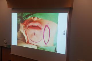 Gliwiccy lekarze dokonali kolejnego na światową skalę przeszczepu narządów szyi