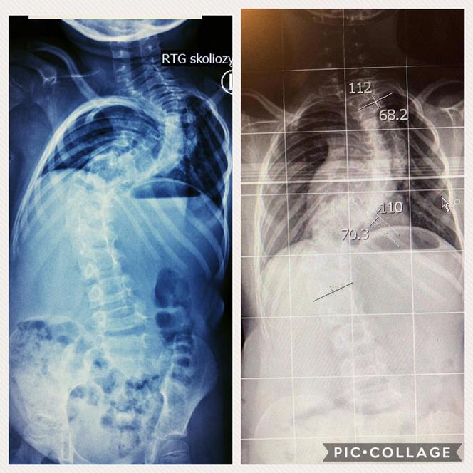 Leczenie w Polsce nie przynosiło rezultatów