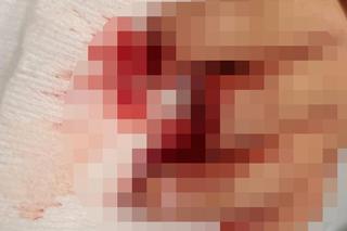  Pies odgryzł dziecku paluszki. Jedn udało się doszyć, drugi zjadł pies. To był bardzo skomplikowany zabieg