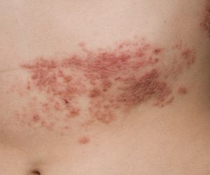 Przyłuszczyca – rodzaje, rozpoznanie,  leczenie