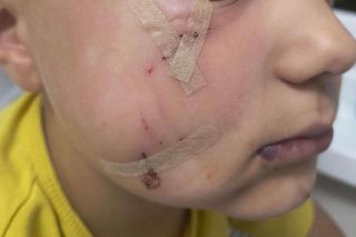 Pogryziony Franek potrzebuje pomocy. Policja szuka właściciela psa. Do szpitala dotarła anonimowa wiadomość