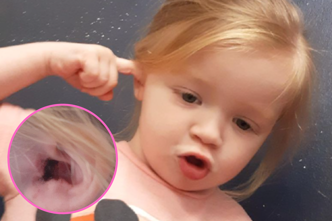 2-letnia dziewczynka miała coś w uchu.