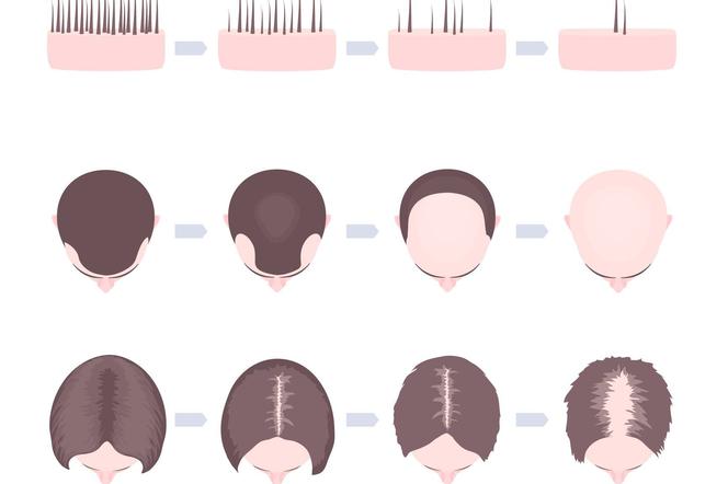 Wypadanie Włosów U Dzieci Dlaczego Dzieci łysieją Przyczyny Objawy Leczenie Mjakmamapl 1582
