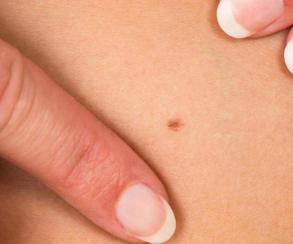 Reguły ABCDE, CUBED i ABCDEF pomagają rozpoznać groźne nowotwory. Lekarze przygotowali poradnik