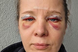 Anna Powierza poddała się drastycznemu zabiegowi