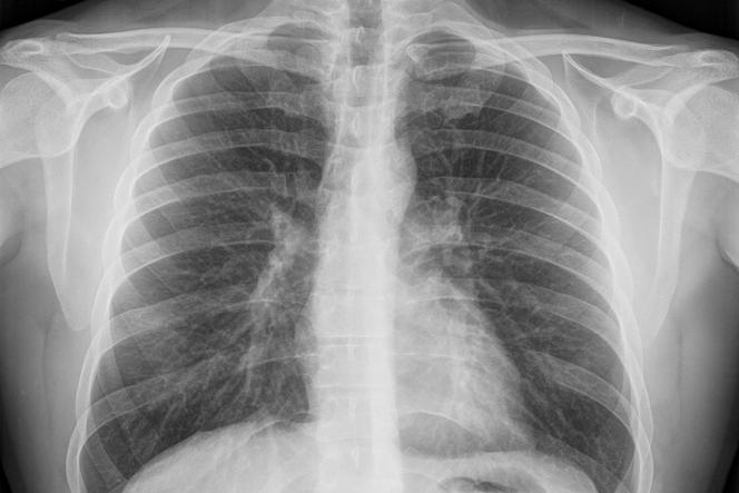 rentgen klatki piersiowej