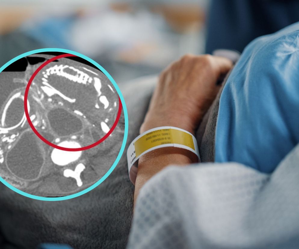 Przez 9 lat nosiła w sobie kamienne dziecko. Odmówiła operacji ratującej życie