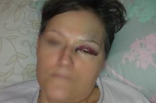 Potrącenie pieszej na pasach na rondzie santockim w Gorzowie. Poszkodowana pokazała poobijane ciało