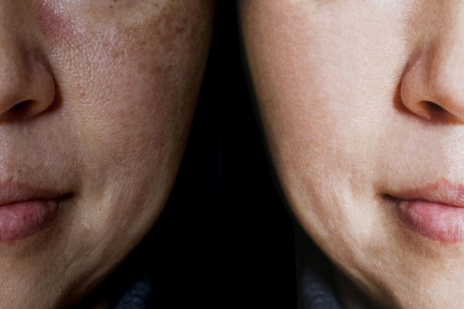 Domowa mikrodermabrazja. Kosztuje 2zł, a efekt jak z profesjonalnego salonu