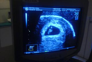 7 tydzień ciąży - USG