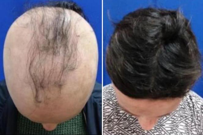 Nowy lek pomoże pacjentom z łysieniem. Niektórzy odzyskali włosy w zaledwie pół roku