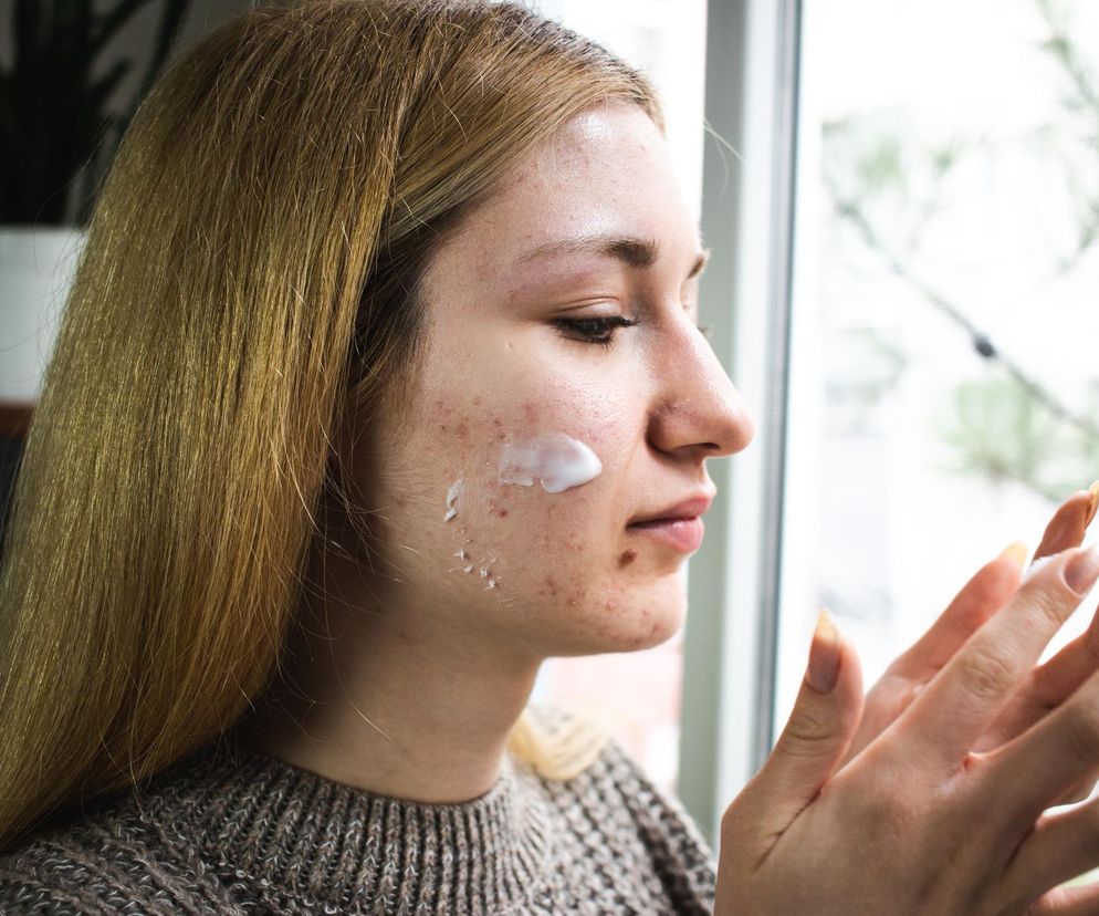 Skuteczna i naturalna. Apteczna maść, która pomaga na trądzik
