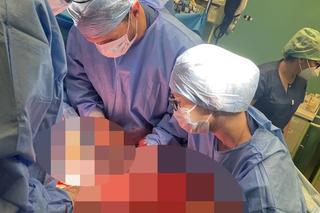 Lekarze ze szpitala Latawiec usunęli gigantycznego guza 38-letniej pacjentce
