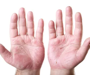 Nieziemsko dobry sposób na suche dłonie. Maść z apteki za 5 zł sprawi, że skóra będzie nawilżona i przestanie pękać