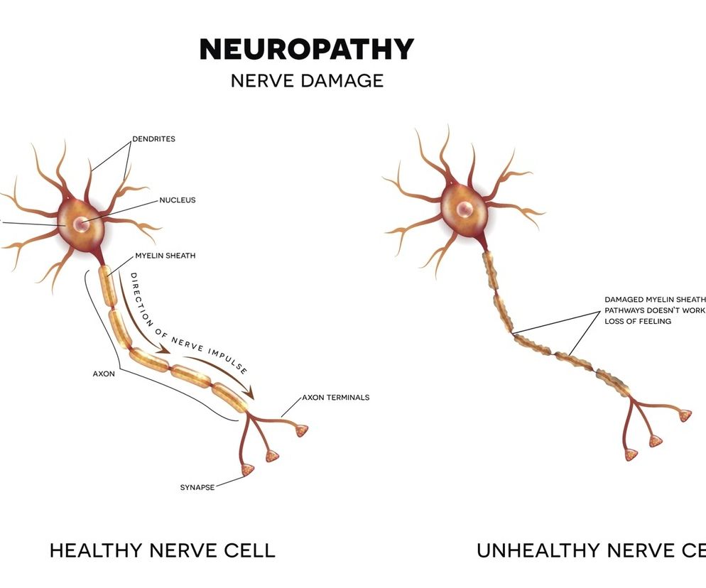 Neuropatia: rodzaje, przyczyny, objawy, leczenie