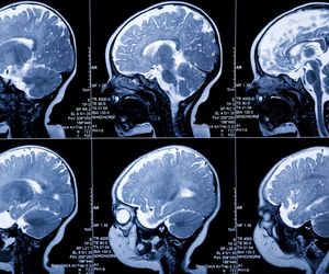 Gruczolak przysadki mózgowej - rodzaje i objawy
