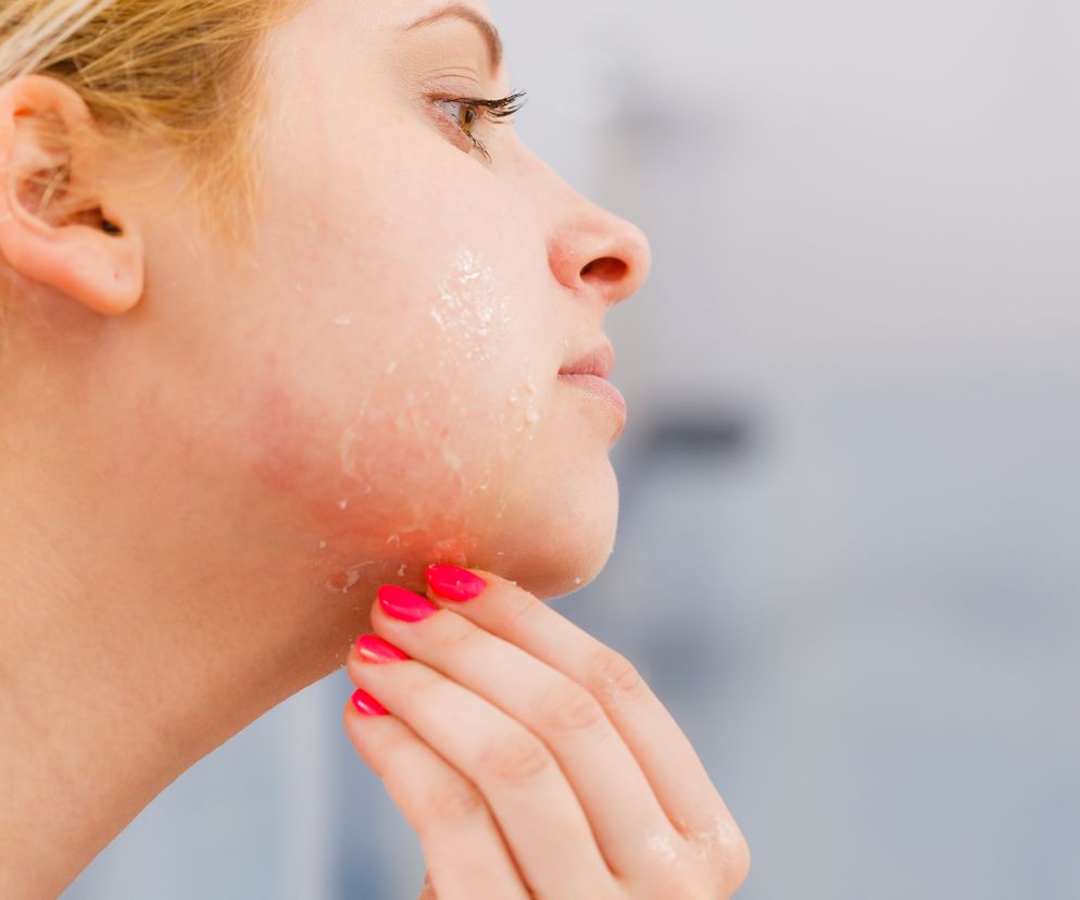 kobieta cierpiąca na erytrodermię