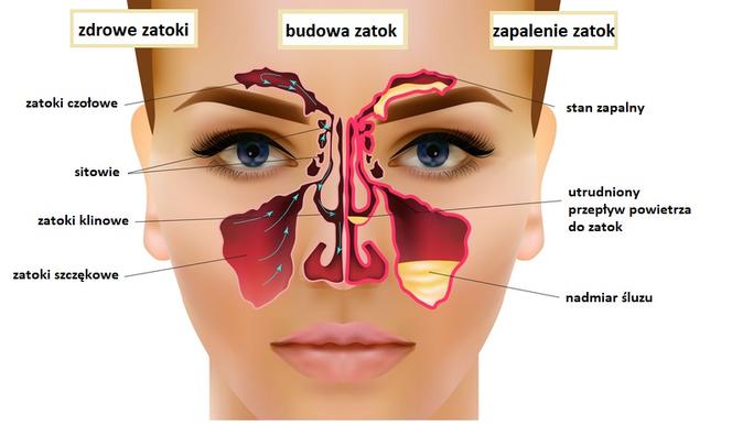 Rak Nosa I Zatok Przyczyny Rodzaje Objawy Leczenie I Rokowania