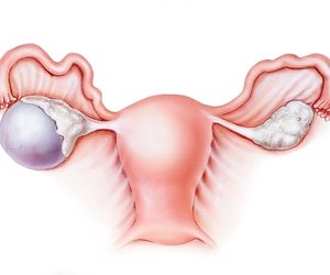 Torbiel czekoladowa: przyczyny, objawy, leczenie