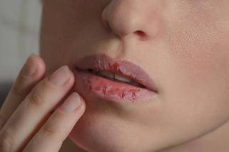 Pękające usta to twój problem? Oto 5 sposobów, które się z nim rozprawią 